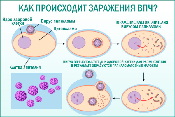 Папилломы под мышками. Причины и лечение, как избавиться Папилломы под мышками. Причины и лечение, как избавиться