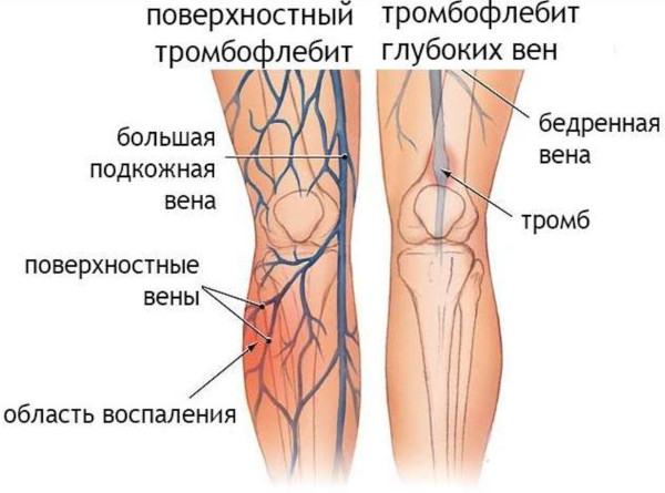 Жемчужные ванны. Что это такое, показания Жемчужные ванны. Что это такое, показания