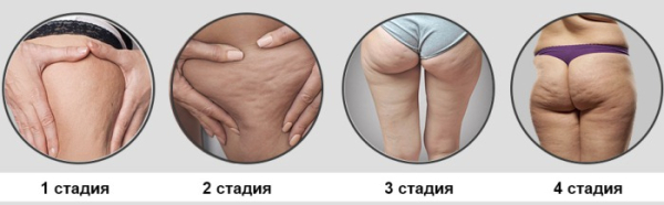 Лучшие антицеллюлитные кремы 2023. Цены и отзывы Лучшие антицеллюлитные кремы 2023. Цены и отзывы