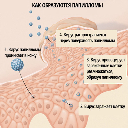 Папилломы под мышками. Причины и лечение, как избавиться Папилломы под мышками. Причины и лечение, как избавиться