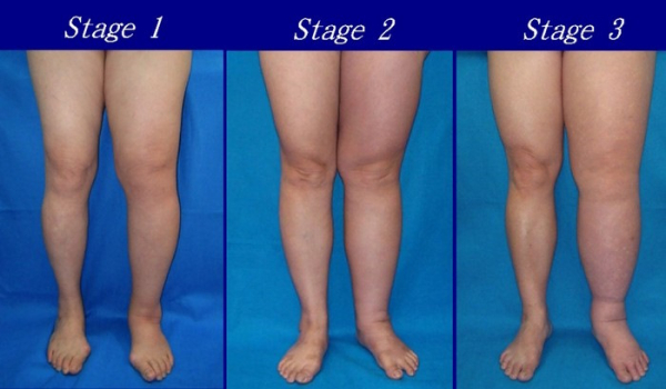 Как разогнать лимфу в организме, убрать отеки, улучшить лимфоотток Как разогнать лимфу в организме, убрать отеки, улучшить лимфоотток