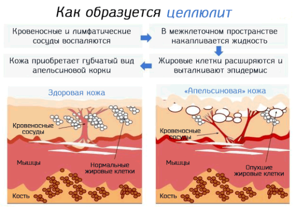 Лучшие антицеллюлитные кремы 2023. Цены и отзывы Лучшие антицеллюлитные кремы 2023. Цены и отзывы