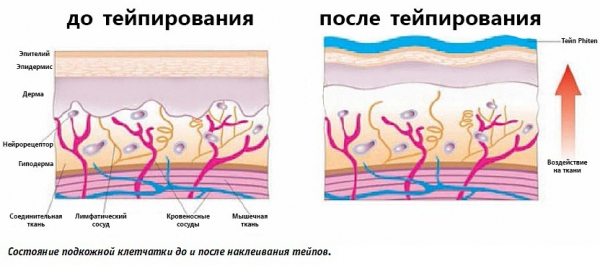 Тейпирование живота и боков для похудения. Схема, как делается, фото, результаты Тейпирование живота и боков для похудения. Схема, как делается, фото, результаты
