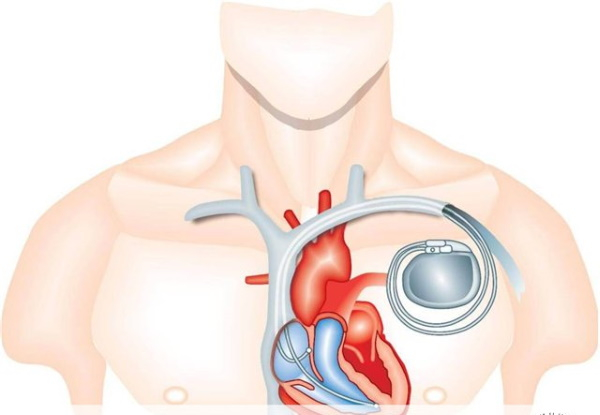 ЕМС тренировки для похудения. Что это такое, упражнения, отзывы врачей, фото до и после ЕМС тренировки для похудения. Что это такое, упражнения, отзывы врачей, фото до и после